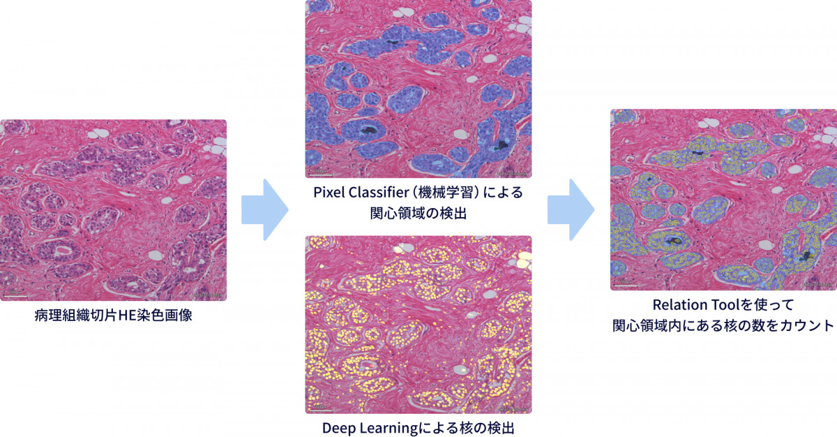 ①病理組織切片HE染色画像 ②Pixel Classifier（機械学習）による関心領域の検出。Deep Learningによる核の検出。 ③Relation Toolを使って関心領域内にある核の数をカウント