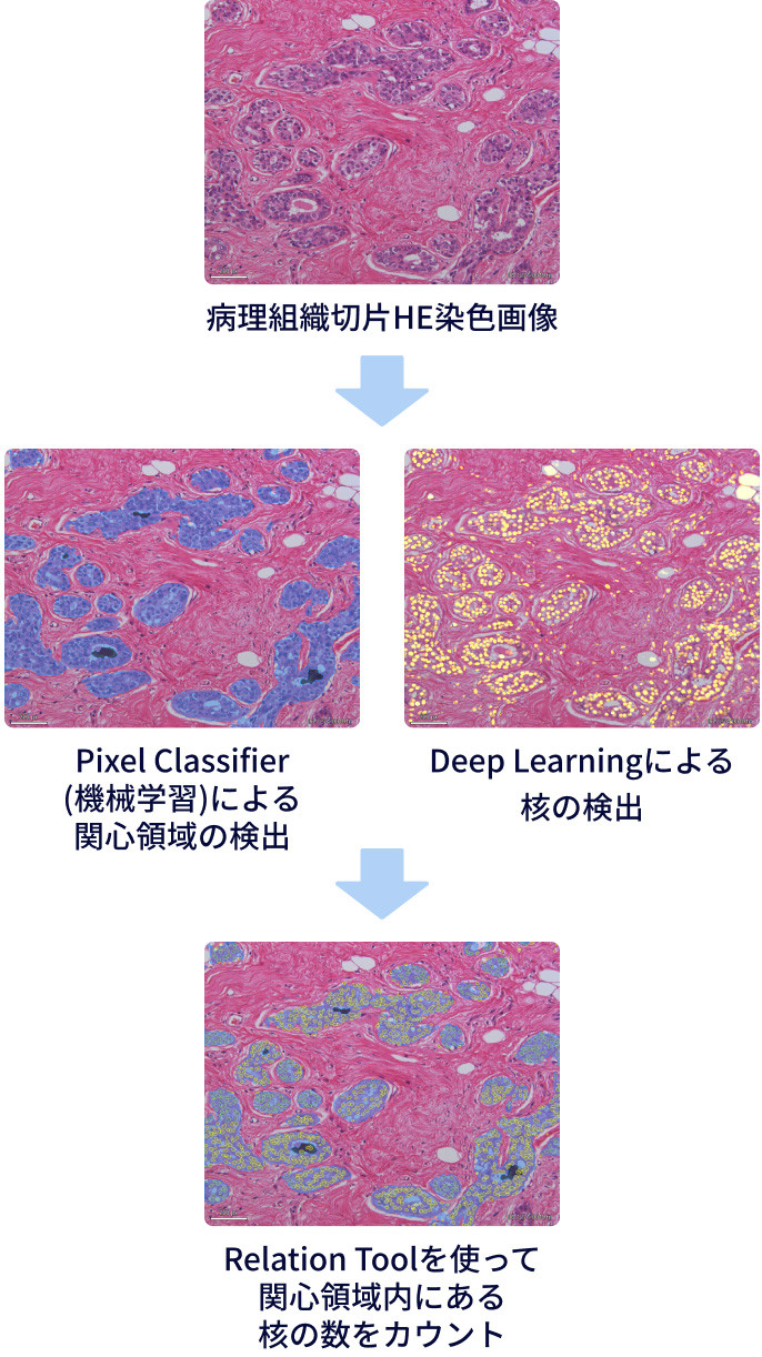 ①病理組織切片HE染色画像 ②Pixel Classifier（機械学習）による関心領域の検出。Deep Learningによる核の検出。 ③Relation Toolを使って関心領域内にある核の数をカウント